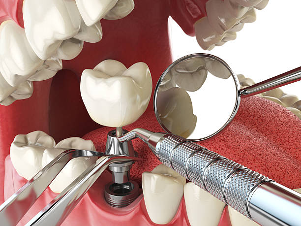 Best Emergency Dental Care for Broken or Chipped Teeth in South River, NM
