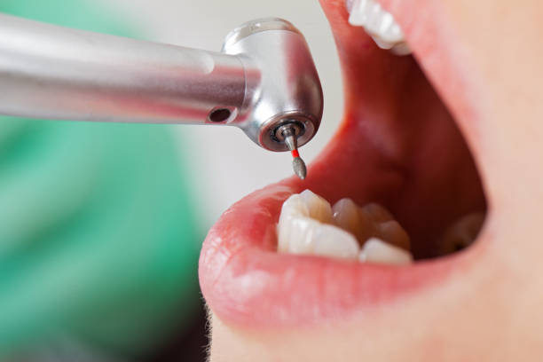 Best Emergency Tooth Extraction in South River, NM